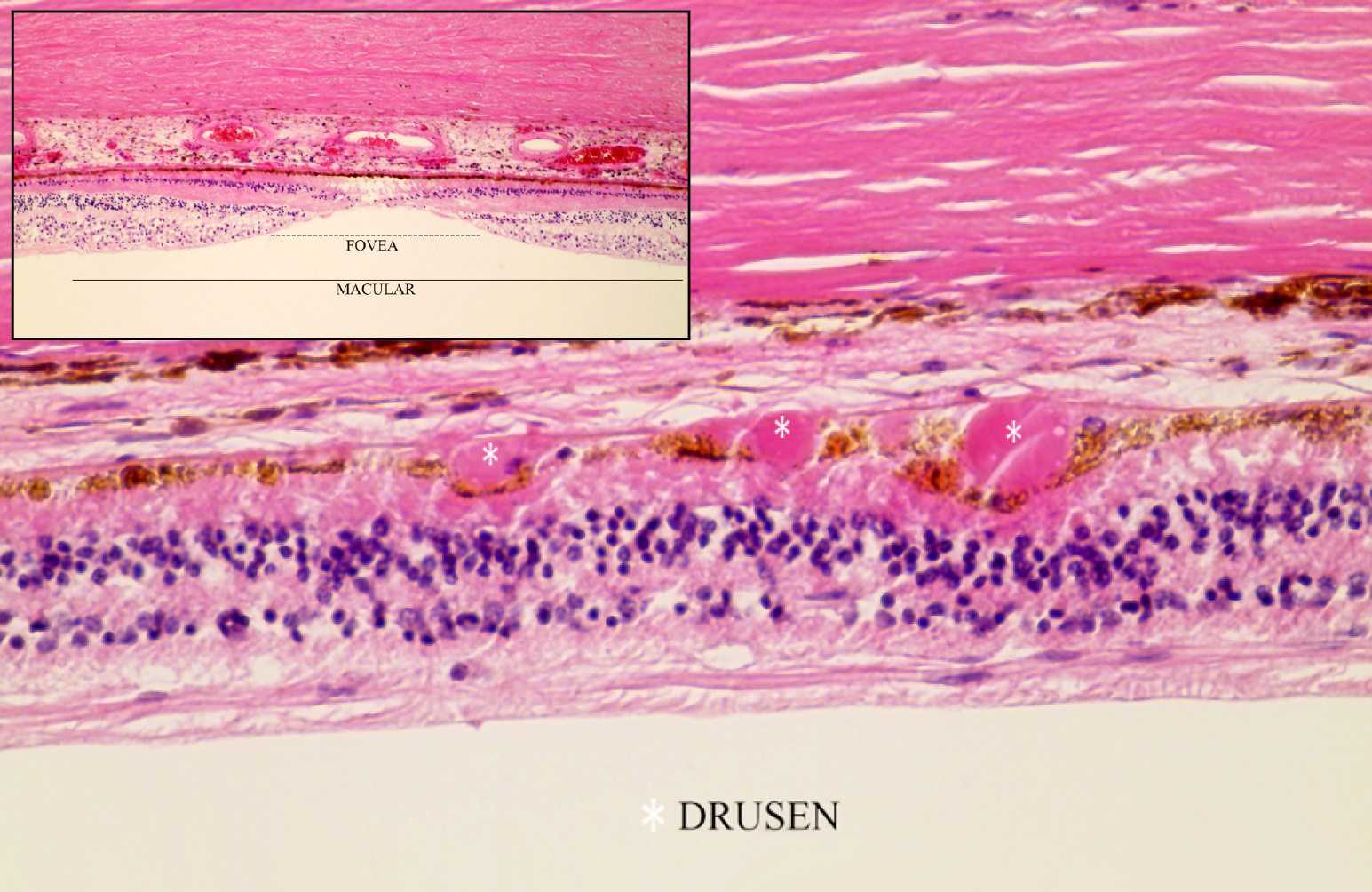 Image showing drusen deposits on retina